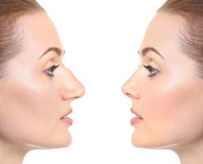 La rhinoplastie