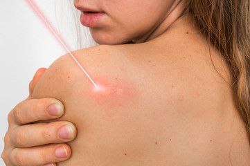 Le laser Urgotouch