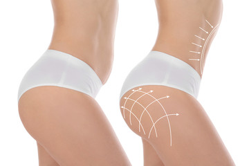 Le lipofilling fessier