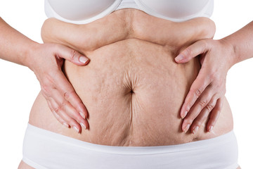 L’abdominoplastie