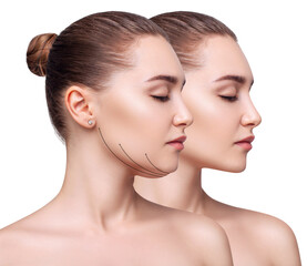 La lipoaspiration cervicale