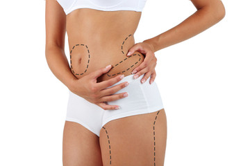 La liposuccion